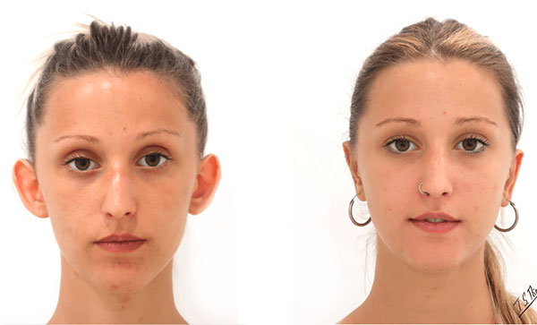 Resultado antes y después de una otoplastia para corregir orejas prominentes.