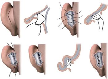 Cirujano aplicando técnicas de otoplastia personalizadas con planificación 3D